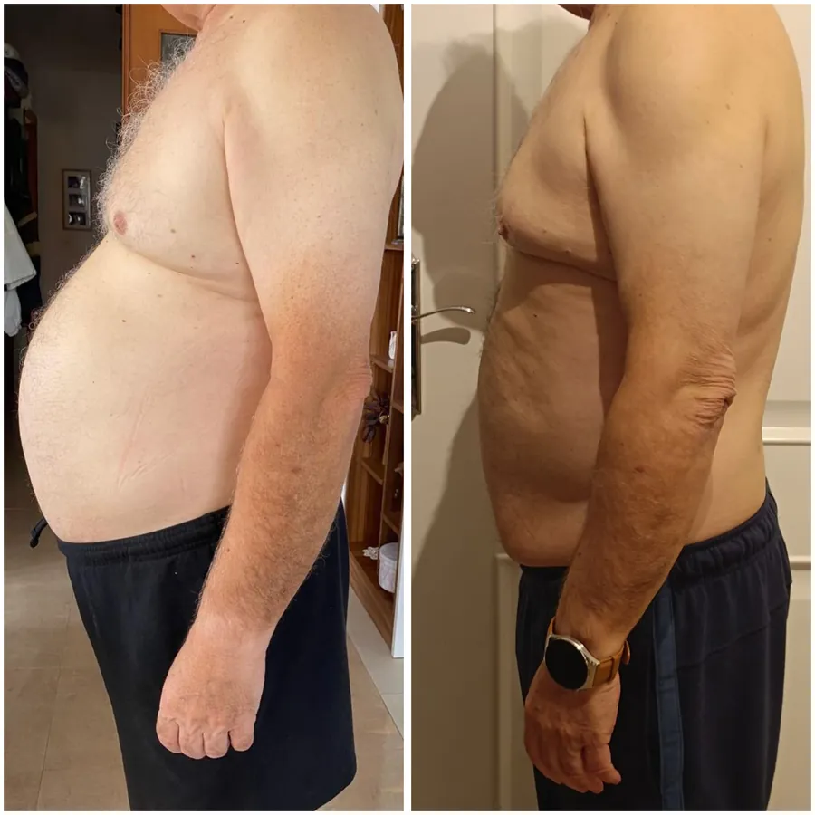 Antes y después de un cliente de 67 años que perdió 10 kg